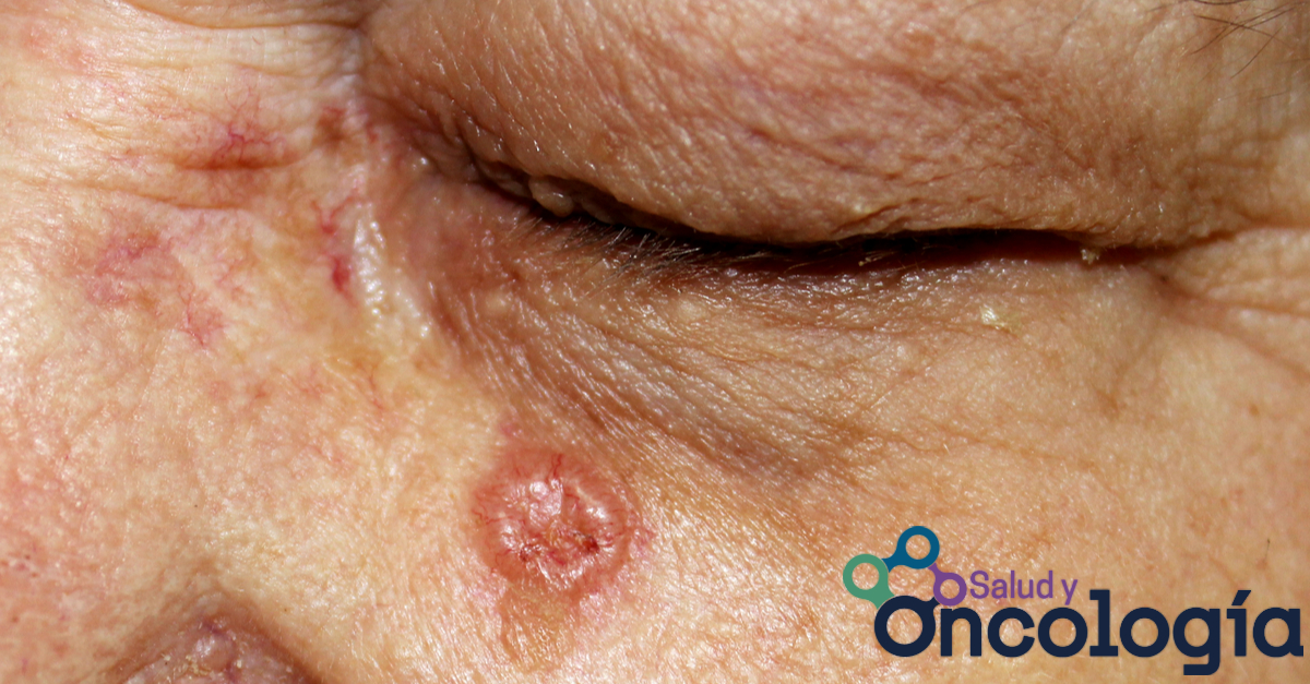 Basal cell carcinoma, a condition that develops in the epidermis