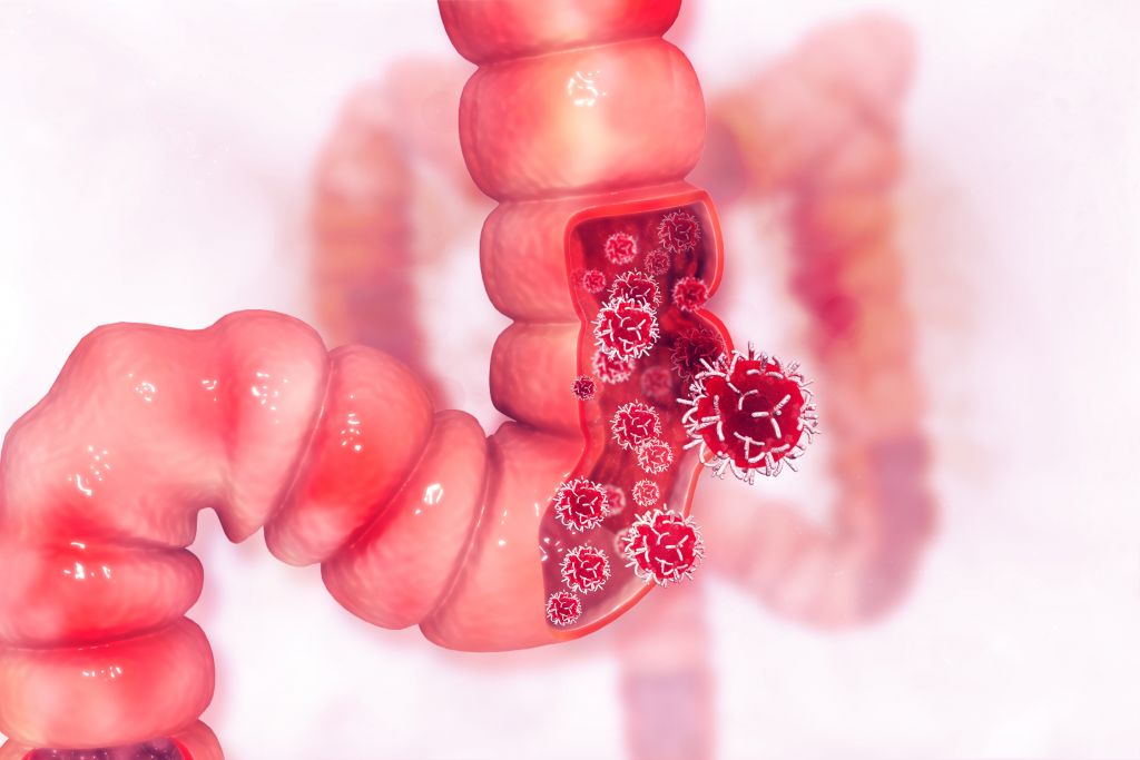 Uso moderado de antibióticos aumentaría el riesgo de cáncer de colon