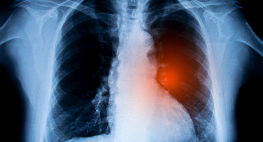 X-ray,Image,Of,Chest.,Lung,Cancer,Concept