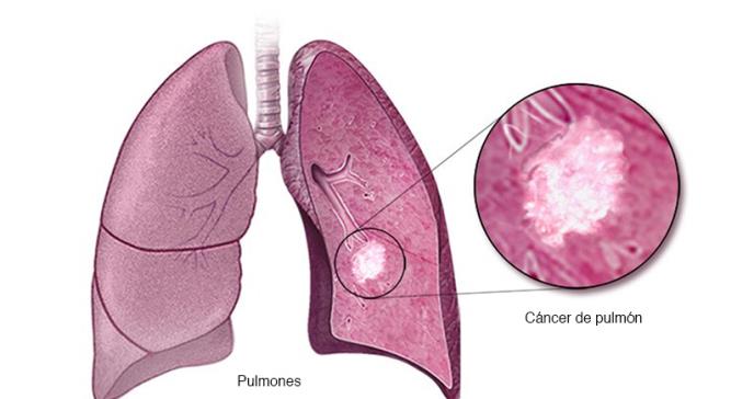cancer-pulmon-focus-0-0-688-364