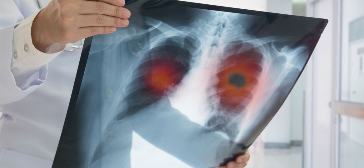 Lung,Cancer,Or,Pneumonia.,Doctor,Check,Up,X-ray,Image,Have