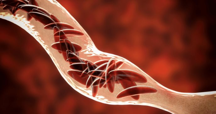La única opción para la supervivencia a largo plazo de los pacientes es el trasplante de células madre hematopoyéticas. Foto: Shutterstock.