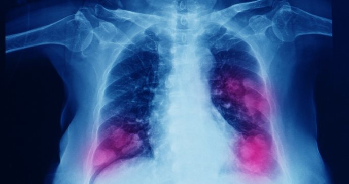 El cáncer de pulmón de células pequeñas en los que nunca han fumado es la séptima causa más común de mortalidad relacionada con el cáncer en todo el mundo. Foto: Shutterstock.
