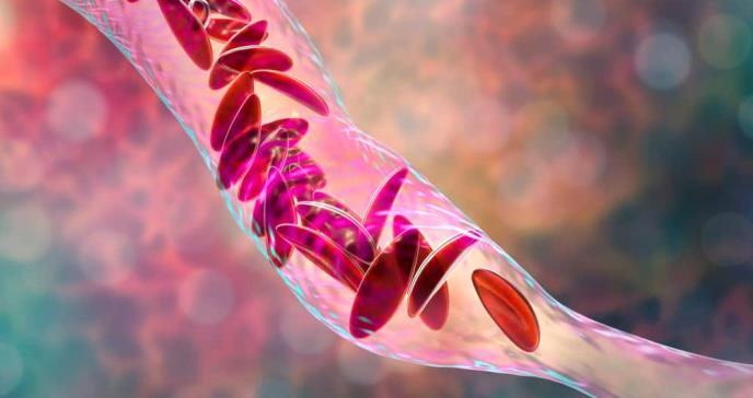 Imagen de anemia falciforme, ilustración 3D. Los bultos de células de la anemia bloquean los vasos sanguíneos. Foto: ShutterStock.